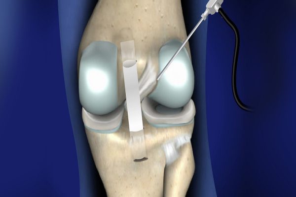 posterior-cruciate-ligament